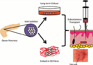 Обещаващи резултати на подкожнa трансплантация при захарен диабет тип 1